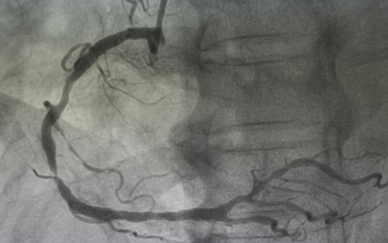 Angiografia naczyń krwionośnych serca.